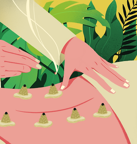 Moxibustion treatment using traditional Chinese Medicine techniques