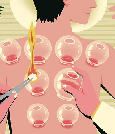 Cupping therapy treatment at Fabi Acupuncture in Didcot